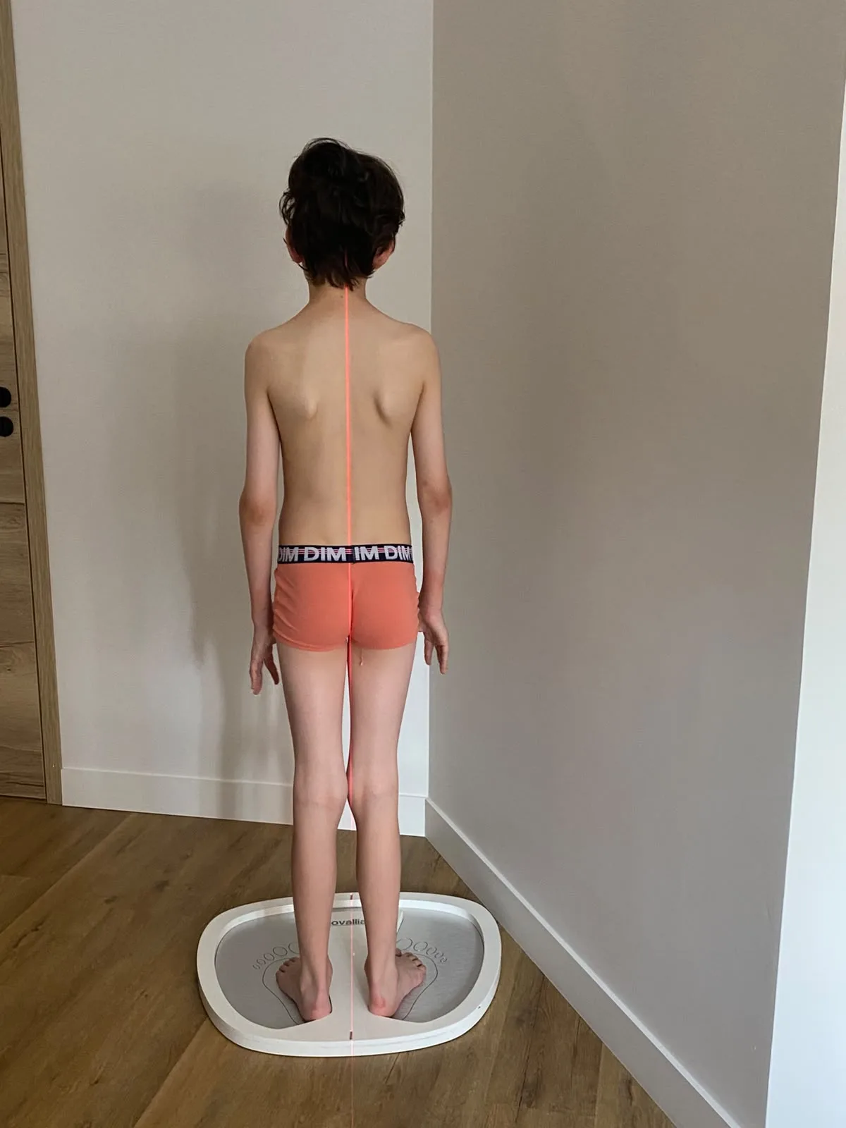 Analyse posturale après la prise en charge, montrant une posture rééquilibrée